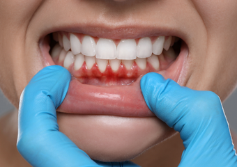 GUM DISEASE TREATMENT