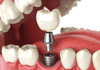 Implants and Surgery